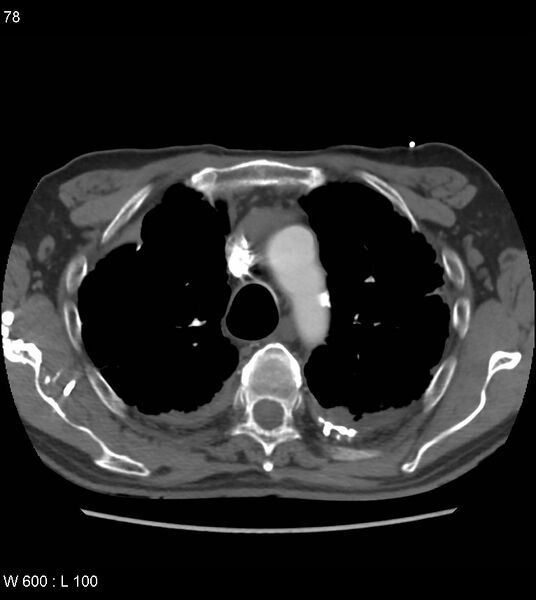 File:Asbestos related lung and pleural disease (Radiopaedia 14377-14301 D 14).jpg
