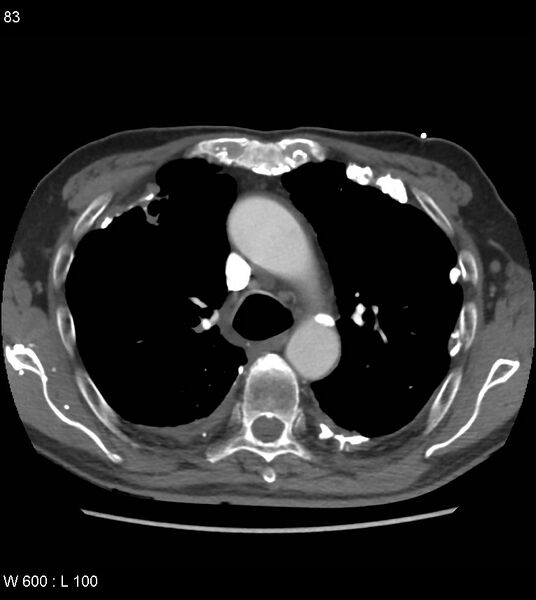 File:Asbestos related lung and pleural disease (Radiopaedia 14377-14301 D 19).jpg