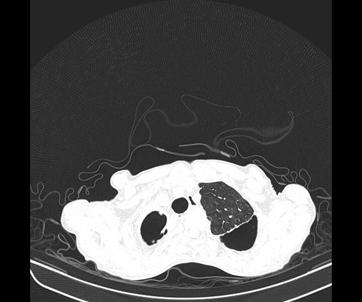 File:Aspergillomas (Radiopaedia 66779-76110 Axial lung window 14).jpg