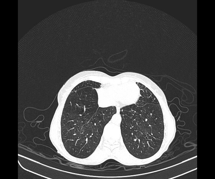 File:Aspergillomas (Radiopaedia 66779-76110 Axial lung window 36).jpg