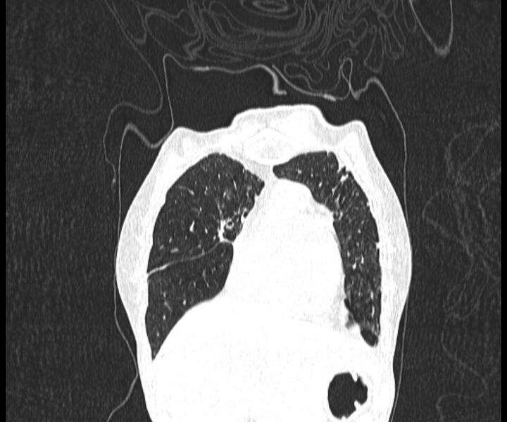 File:Aspergillomas (Radiopaedia 66779-76110 Coronal lung window 4).jpg