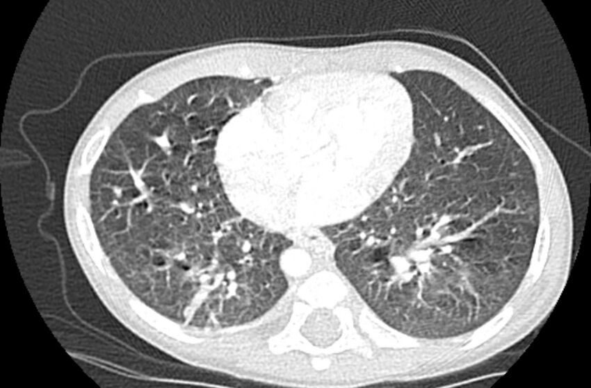 Asplenia syndrome (Radiopaedia 73083-83792 Axial lung window 50).jpg