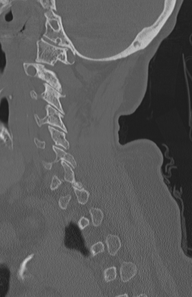 File:Atlanto-axial subluxation (Radiopaedia 36610-38176 Sagittal bone window 29).png