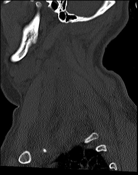 File:Atlanto-occipital dissociation - Traynelis type 1 (Radiopaedia 87570-103948 Sagittal bone window 66).jpg