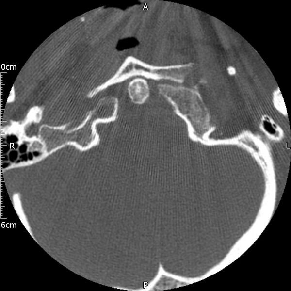 File:Atlas fracture with Currarino type A congenital defect (Radiopaedia 71747-82144 Axial bone window 17).jpg