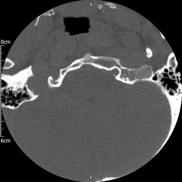 File:Atlas fracture with Currarino type A congenital defect (Radiopaedia 71747-82144 Axial bone window 5).jpg