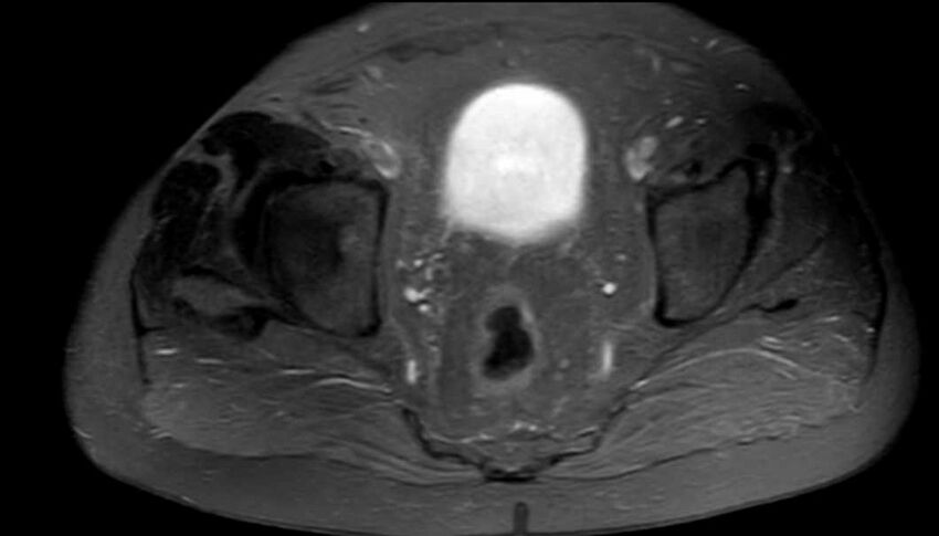 Atypical lipomatous tumor - thigh (Radiopaedia 68975-78734 Axial PD fat sat 98).jpg