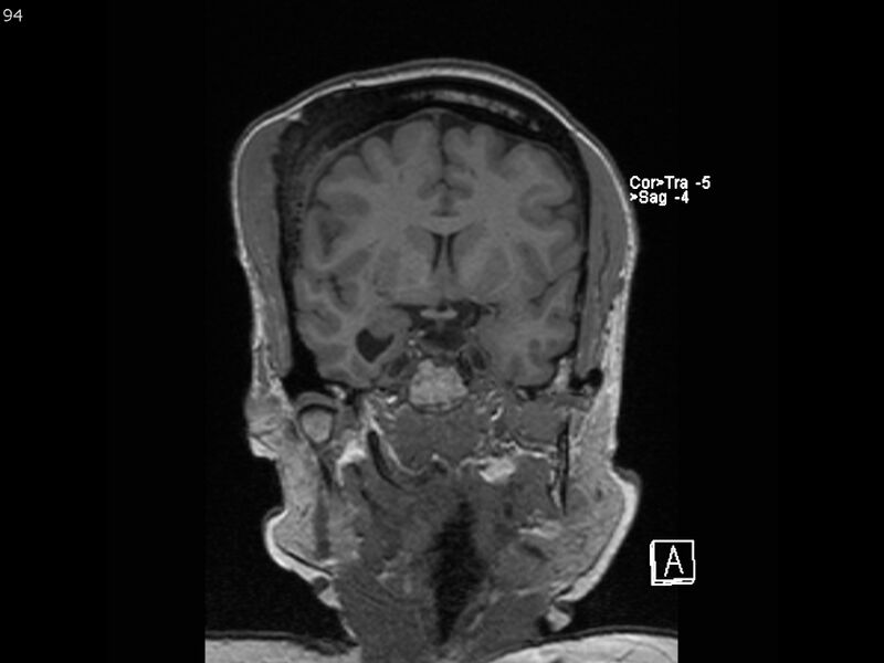 File:Atypical meningioma - intraosseous (Radiopaedia 64915-74572 Coronal T1 94).jpg