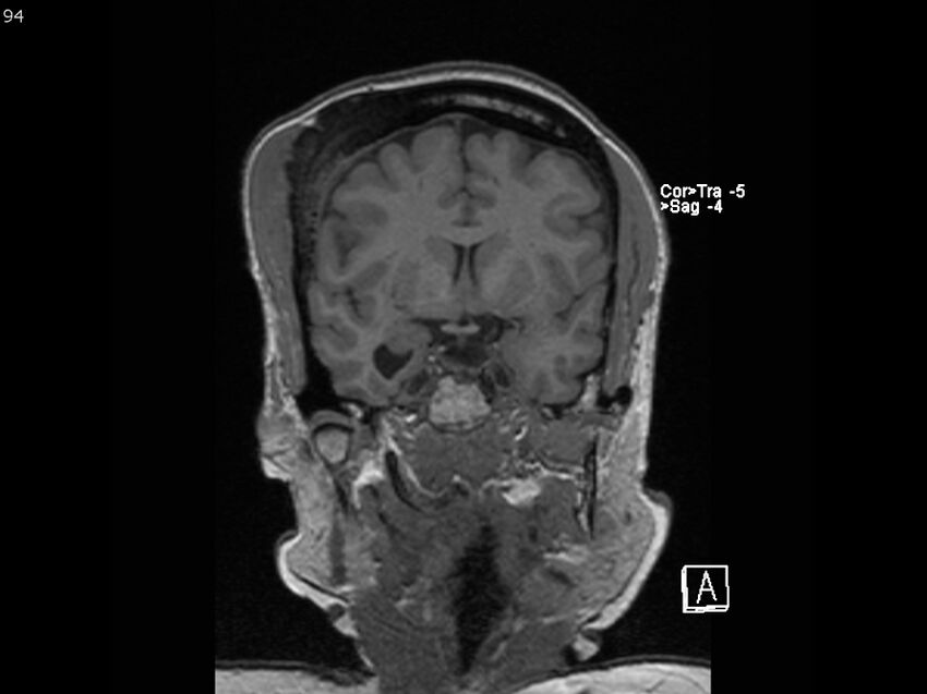 Atypical meningioma - intraosseous (Radiopaedia 64915-74572 Coronal T1 94).jpg