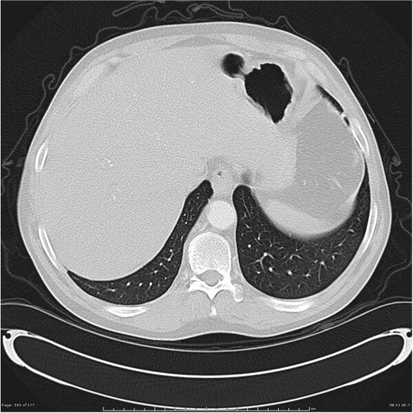 File:Atypical pneumonia - Q fever (Radiopaedia 21993-21989 lung window 44).jpg
