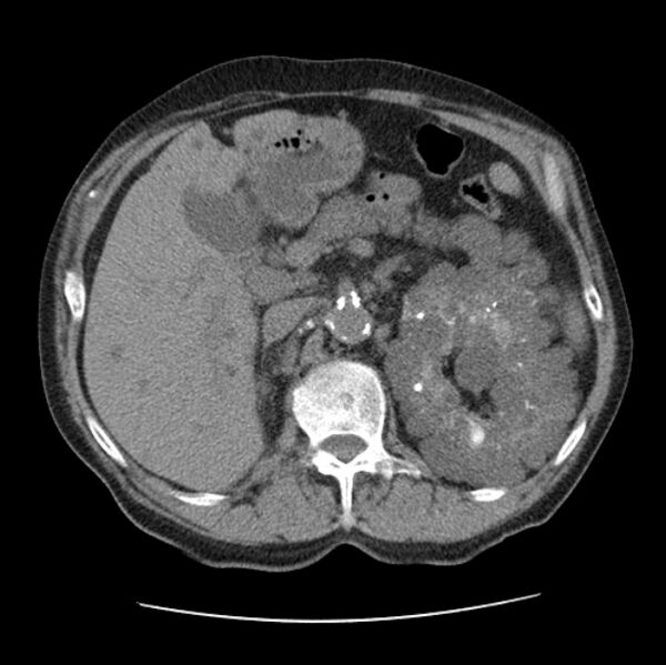 File:Autosomal dominant polycystic kidney disease (Radiopaedia 27851-28094 Axial non-contrast 62).jpg