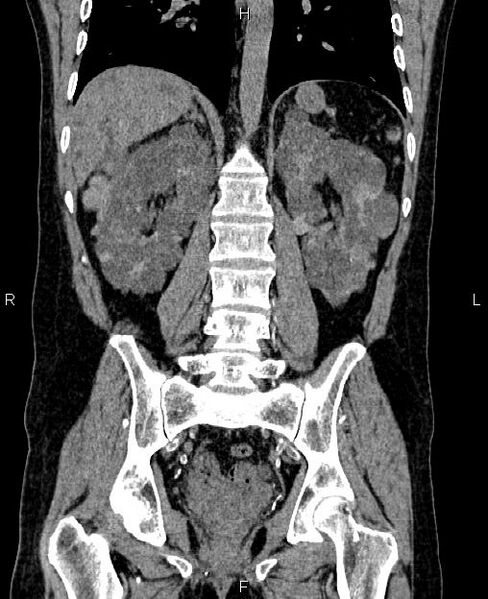 File:Autosomal dominant polycystic kidney disease (Radiopaedia 87830-104287 Coronal non-contrast 42).jpg