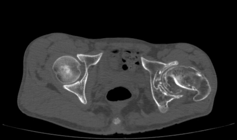 File:Avascular necrosis of the left hip (Radiopaedia 75068-86125 Axial bone window 57).jpg