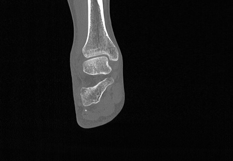 File:Avulsion fractures of talus and calcaneus (Radiopaedia 48277-53155 Coronal bone window 58).jpg