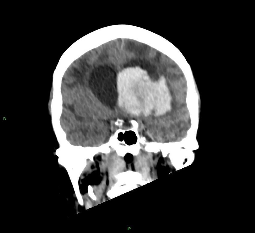 Basal ganglia hemorrhage (Radiopaedia 58766-65988 Coronal non-contrast 42).jpg