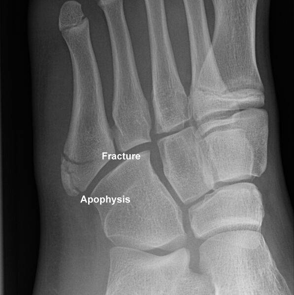 File:Base of 5th metatarsal fracture and apophysis (Radiopaedia 10842-27651 A 1).jpg