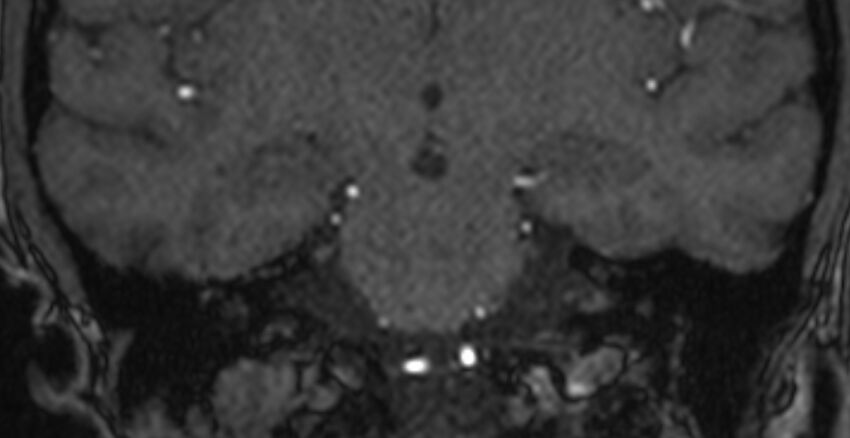 Basilar artery fenestration (Radiopaedia 74537-85455 Coronal MRA TOF 63).jpg