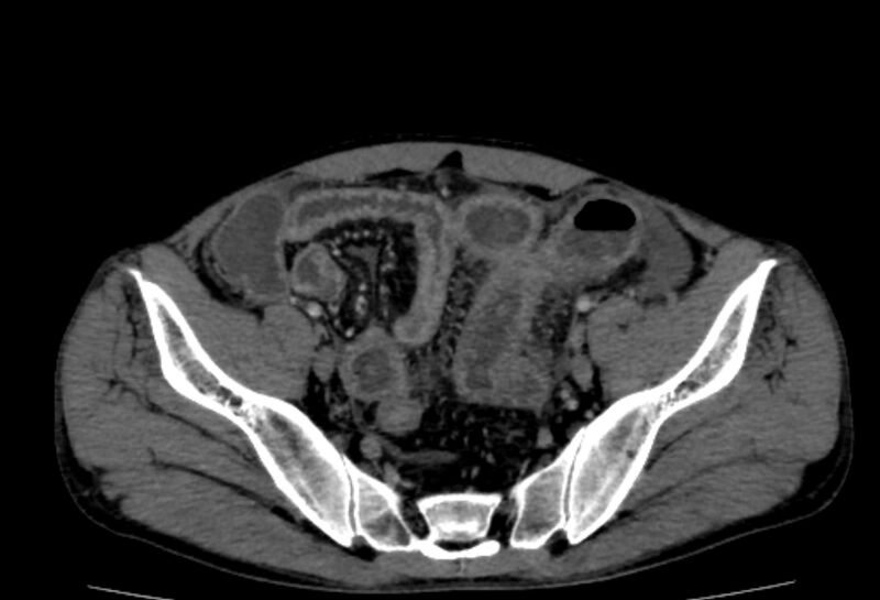 File:Behçet's disease- abdominal vasculitis (Radiopaedia 55955-62570 A 73).jpg