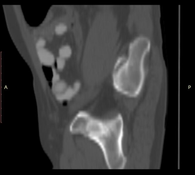 File:Bertolotti syndrome (Radiopaedia 58974-66235 Sagittal bone window 55).jpg