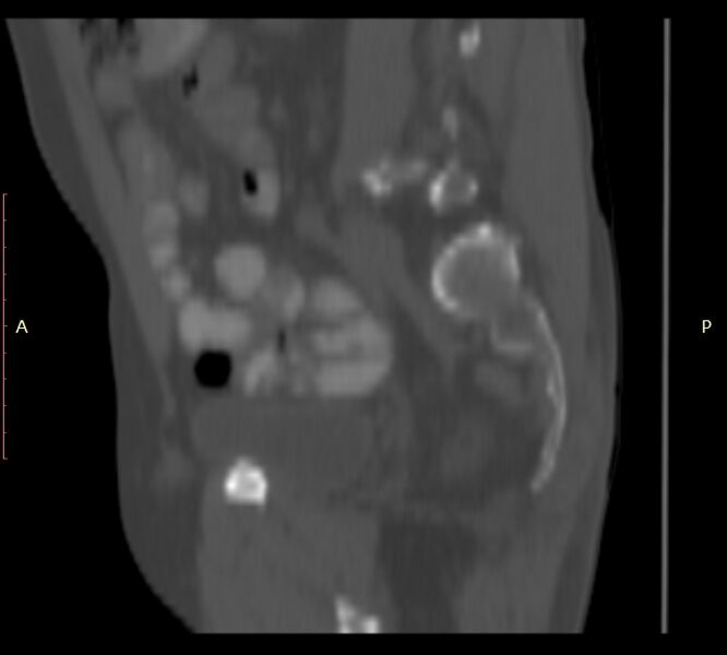 File:Bertolotti syndrome (Radiopaedia 58974-66235 Sagittal bone window 9).jpg