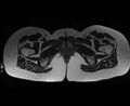 Bicornuate bicollis uterus (Radiopaedia 61626-69616 Axial T2 40).jpg