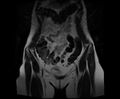 Bicornuate bicollis uterus (Radiopaedia 61626-69616 Coronal T2 5).jpg
