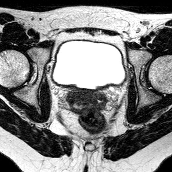File:Bicornuate uterus (Radiopaedia 11104-11492 Axial T2 13).jpg