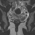Bicornuate uterus (Radiopaedia 24677-24949 Coronal T2 11).jpg
