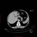 Bifid ureter (Radiopaedia 47604-52253 Axial C+ delayed 2).jpg
