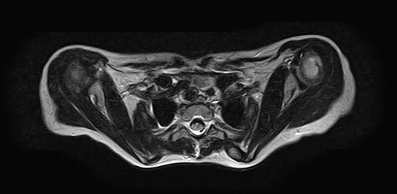 File:Bilateral Sprengel deformity with Klippel-Feil syndrome (Radiopaedia 66395-75650 Axial T2 21).jpg