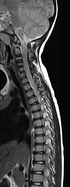 File:Bilateral Sprengel deformity with Klippel-Feil syndrome (Radiopaedia 66395-75650 Sagittal T2 5).jpg