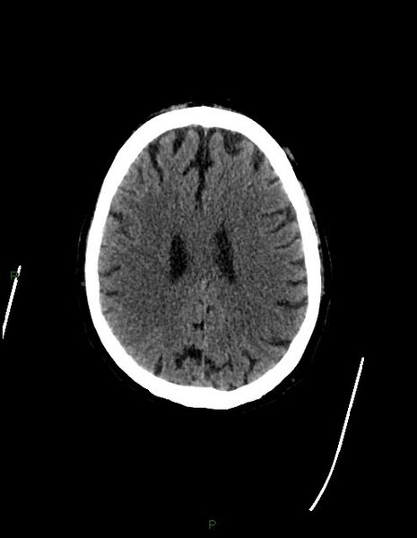 File:Bilateral acute middle cerebral artery territory infarcts (Radiopaedia 77319-89401 Axial non-contrast 59).jpg