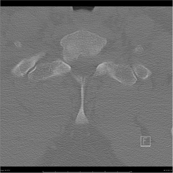 File:Bilateral cervical ribs (Radiopaedia 25868-26017 Axial bone window 46).jpg
