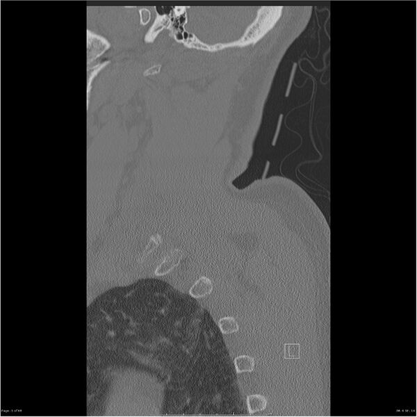 File:Bilateral cervical ribs (Radiopaedia 25868-26017 Sagittal bone window 5).jpg