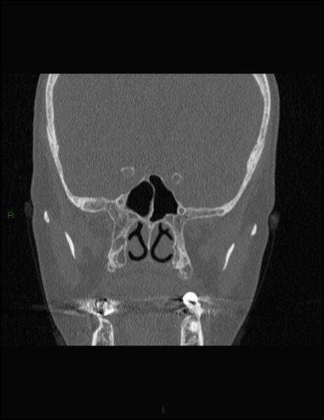 File:Bilateral frontal mucoceles (Radiopaedia 82352-96454 Coronal 208).jpg