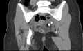 Bilateral mature cystic ovarian teratoma (Radiopaedia 88821-105592 Coronal non-contrast 25).jpg