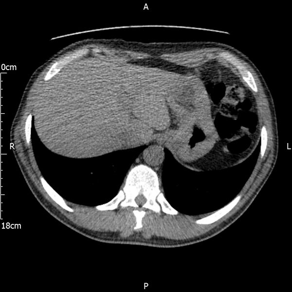 File:Bilateral medullary nephrocalcinosis with ureteric calculi (Radiopaedia 71269-81569 Axial non-contrast 9).jpg