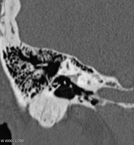 File:Bilateral otosclerosis with left stapes prosthesis (Radiopaedia 5567-7302 Coronal bone window 1).jpg