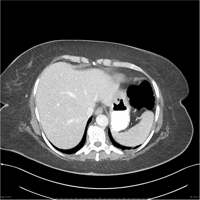 Bilateral psoas hematomas (Radiopaedia 24057-24279 A 13).jpg