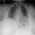Bilateral shoulder injuries on chest x-ray (Radiopaedia 50809-56295 Frontal 1).jpg