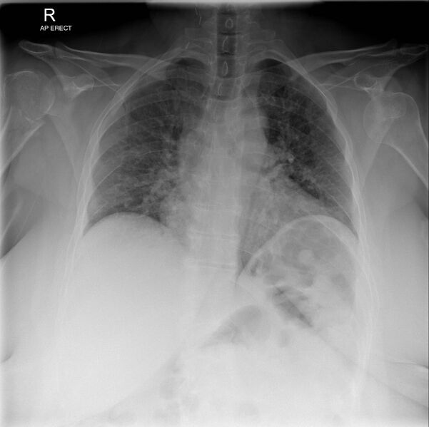 File:Bilateral shoulder injuries on chest x-ray (Radiopaedia 50809-56295 Frontal 1).jpg