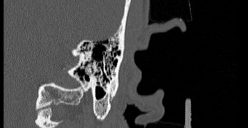 File:Bilateral temporal bone fractures (Radiopaedia 29482-29970 Coronal 244).jpg