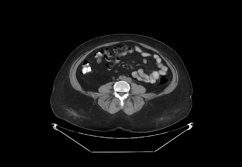 File:Bilateral urolithiasis with incidentally detected splenic artery aneurysm and left inferior vena cava (Radiopaedia 44467-48123 Axial non-contrast 35).jpg
