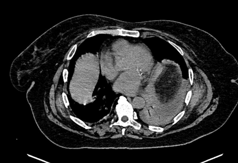 File:Biliary pancreatitis (Radiopaedia 72289-82823 Axial non-contrast 14).jpg