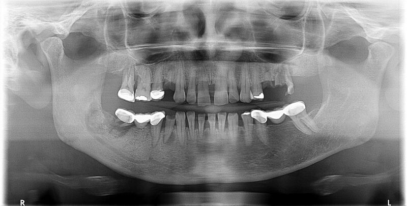 File:Bisphosphonate-related osteonecrosis of the jaw (Radiopaedia 71324-81640 Frontal 1).jpg