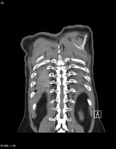 File:Boerhaave syndrome with tension pneumothorax (Radiopaedia 56794-63605 B 33).jpg