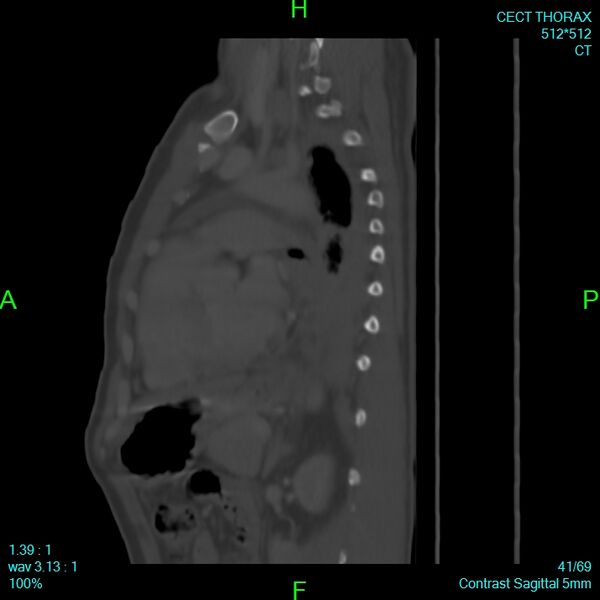 File:Bone metastases from lung carcinoma (Radiopaedia 54703-60937 Sagittal bone window 41).jpg
