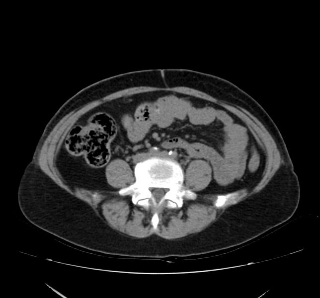 File:Bosniak renal cyst - type IV (Radiopaedia 22929-22953 Axial non-contrast 38).jpg