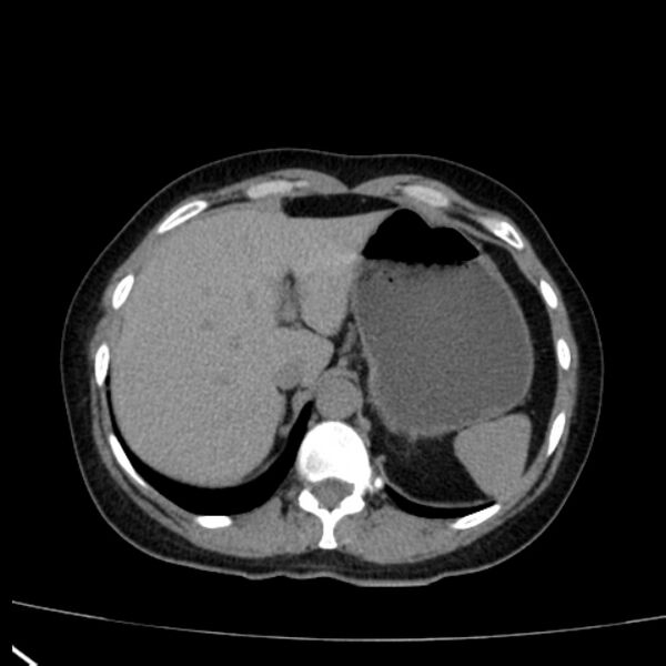 File:Bosniak renal cyst - type I (Radiopaedia 27479-27675 Axial non-contrast 17).jpg