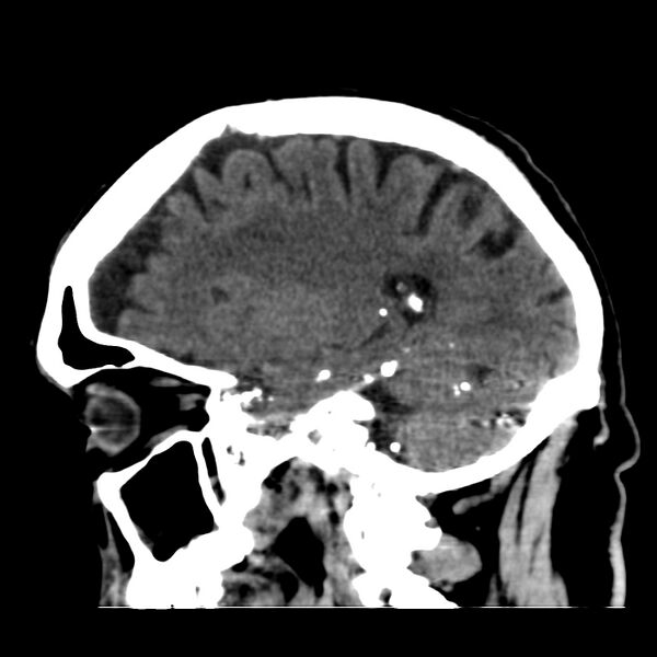 File:Brain Pantopaque remnants (Radiopaedia 78403-91048 C 38).jpg